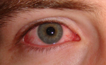 Conjunctivitis